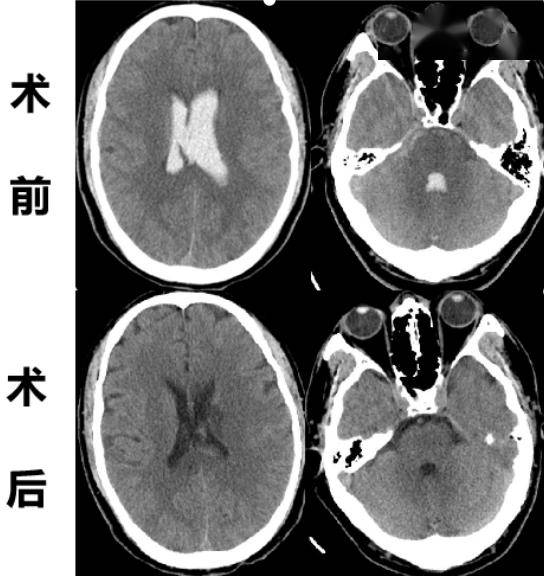 【朝医新闻】石景山院区神经外科与急诊医学科联合救治脑出血